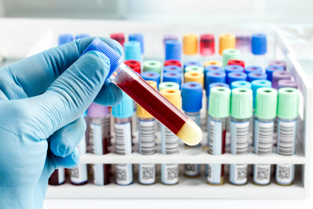 hand of a lab technician holding blood tube test and background a rack of color tubes with blood samples other patients / laboratory technician holding a blood tube test