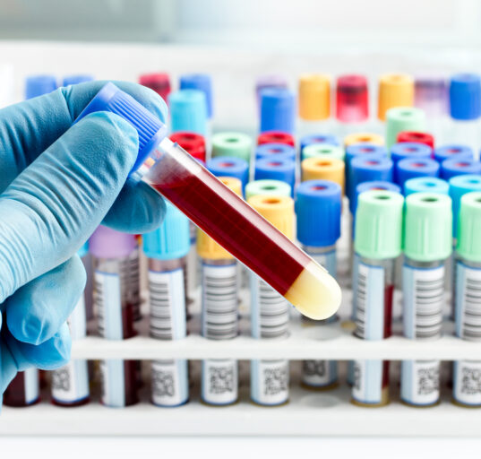 hand of a lab technician holding blood tube test and background a rack of color tubes with blood samples other patients / laboratory technician holding a blood tube test